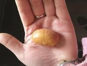 传说的鸡宝？肥母鸡多年不下蛋 宰杀剖肚取出硕大异物(传说中的鸡宝是什么样子的)