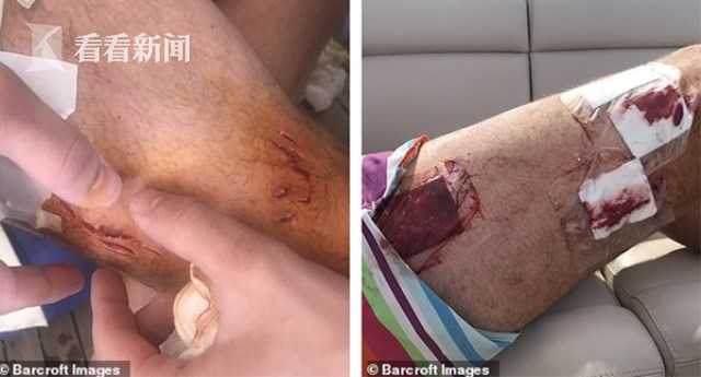 奥地利男子潜水遇远洋白鳍鲨险丧命 被狠咬缝50针