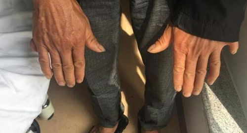 28岁男子天生4肾 天生四肾的男人叫王开炼(男子天生阴阳眼)