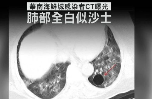 新加坡新增2例新冠肺炎确诊病例 累计确诊112例(新加坡昨日新增新冠)
