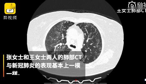 胸部CT都是毛玻璃影 难道是新冠病毒? 管床医生李凤芝反复询(毛霉菌胸部ct)