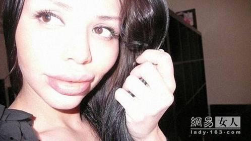 玻尿酸丰唇后像香肠嘴 玻尿酸丰唇肿成香肠嘴照片(玻尿酸丰唇打几次就永久了)