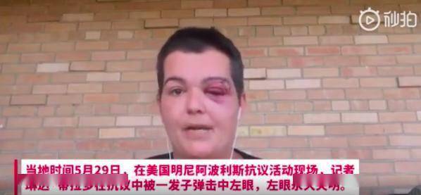 美国记者被警察击中眼睛:想在美国做新冠肺炎检测,只需要一个眼