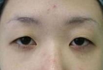 景甜承认整形失败 双眼皮埋线失败变成了悲伤蛙