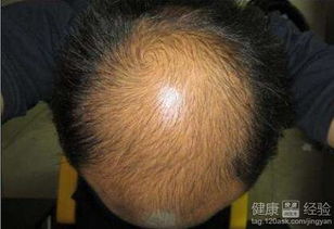频繁洗头会导致脱发吗?医生说实话!是这样吗?(经常洗发会导致脱发吗)