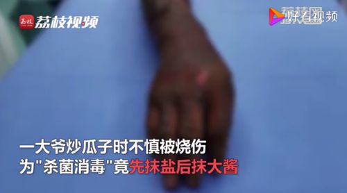 58岁杨师傅意外被烧伤 医生提醒:你用过这些土法吗? 以后不