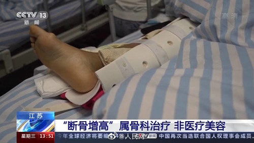 骨折增加手术严禁用于美容项目(骨折手术后体重会增加吗)