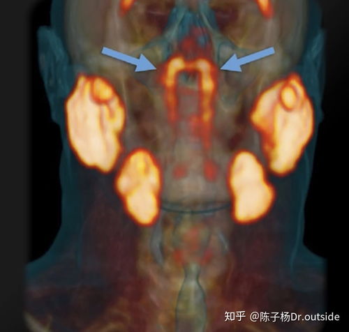 唾液腺:具有放射治疗风险的潜在新器官