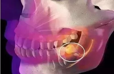 应该拔掉智齿吗? 智齿拔掉后脸型变化图