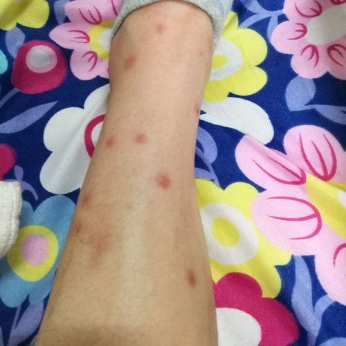 家里的跳蚤怕什么，最怕高温和阳光 大办法教你彻底消灭跳蚤 跳蚤怕什么气味