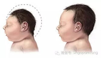 歌舞伎综合征真的很漂亮吗 歌舞伎综合征真的到成年就死吗